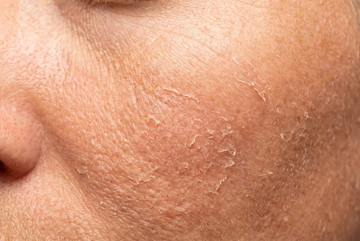 Skin profile for dry and dehydrated skin