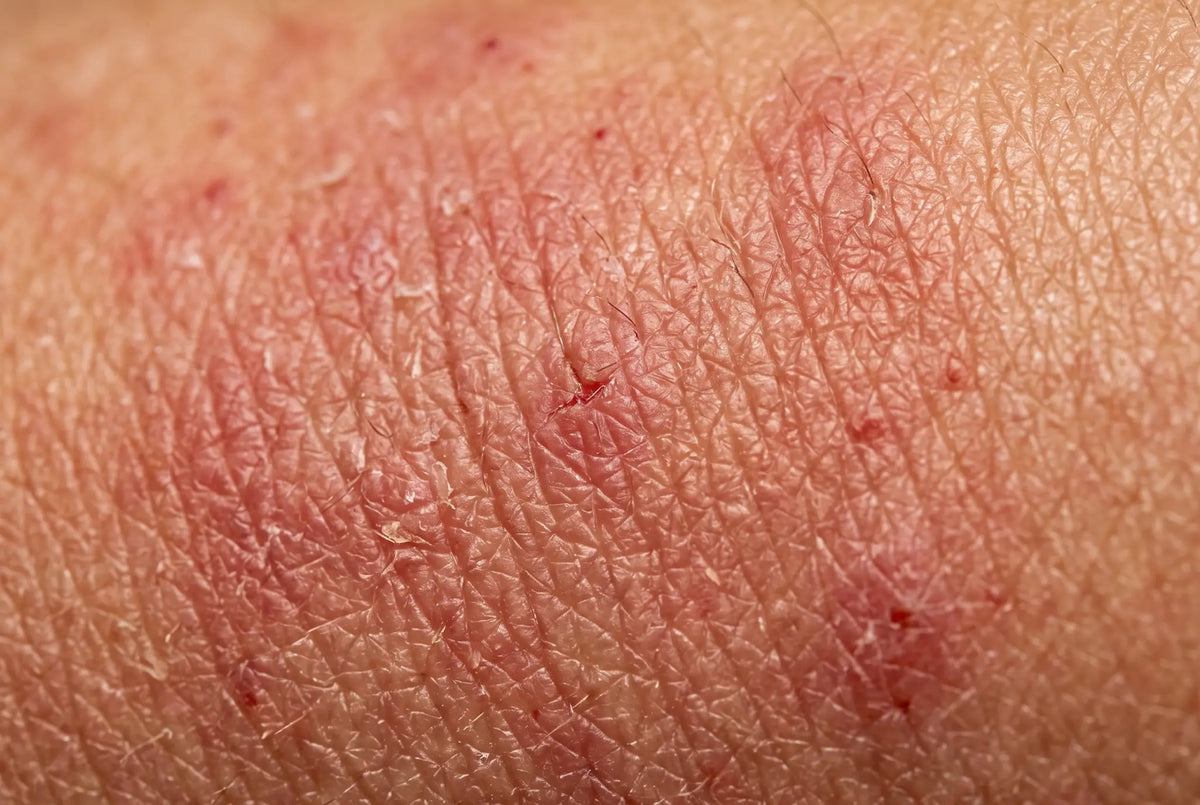 GHK-Cu protocol for sensitive skin